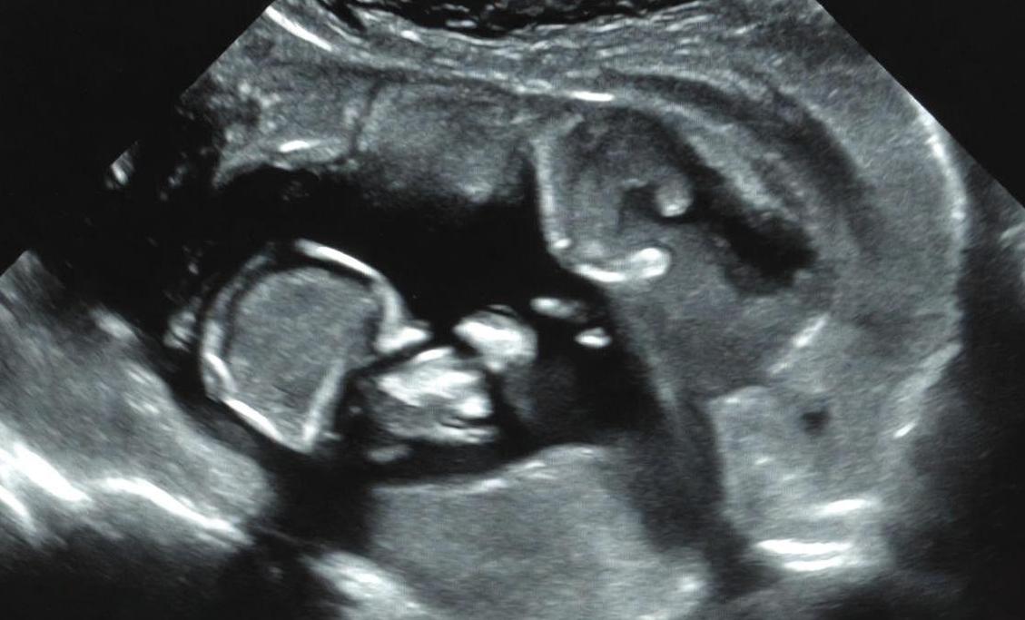 Россиянам сообщили, когда следует проводить ЭКО